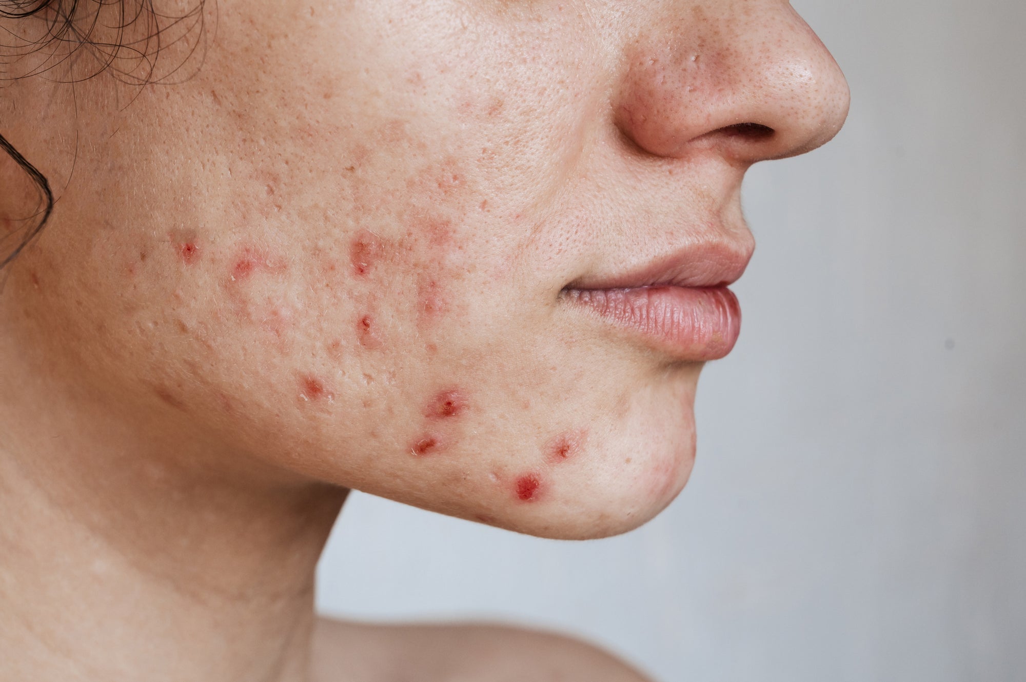 Tackling Acne: The Skintifix Way